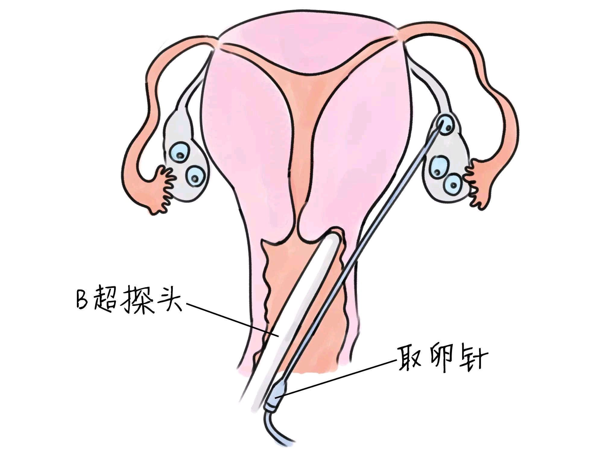阳痿